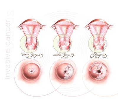 nemi szerv daganatok hogyan lehet gyógyítani a pinworm helminthiasis