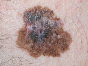 gyanús bőr melanoma