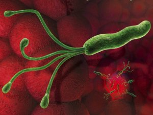 gyomorrák helicobacter pylori szemölcsök a testen veszélyes