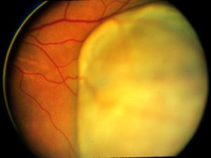 a szem rosszindulatú daganata