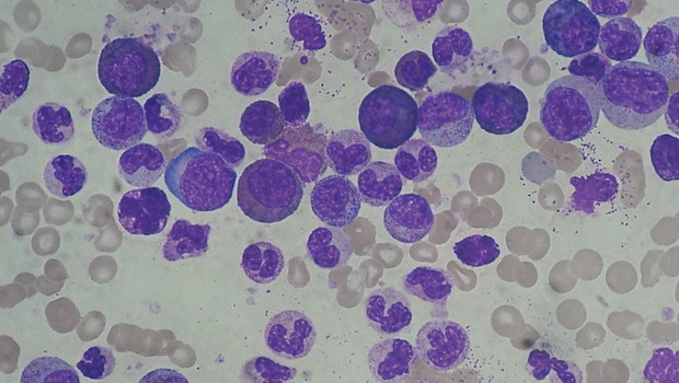 Krónikus myeloid leukémiában szenvedő beteg vérének mikroszkópos képe. Forrás: WikiMédia (CC)