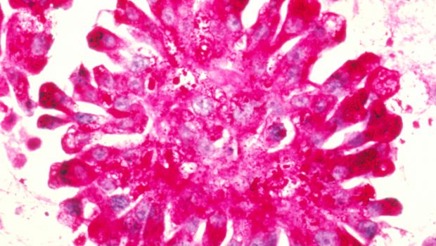 szarkóma rák előnyei diagnózis b80 enterobiasis