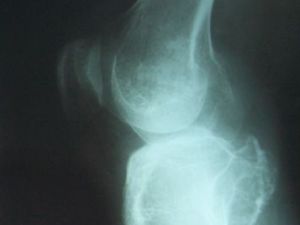 röntgen prosztatitis