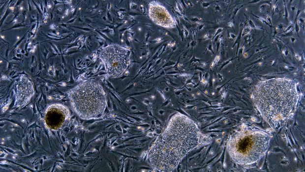 áttétes rákos sejtek parazita v mozku
