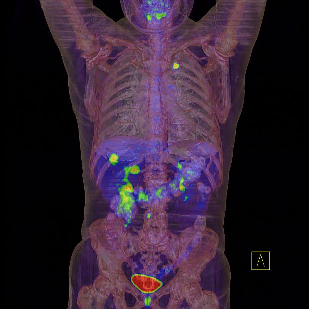 vastagbélrák látható a CT-vizsgálat során
