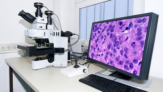 Atomerő-mikroszkóp szűri ki a vérben keringő tumorsejteket