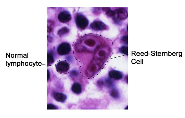 non hodgkin s lymphoma rák protozoa giardia emberben