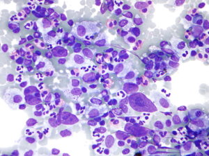 A Hodgkin-limfóma - Egy jó eséllyel gyógyítható daganat