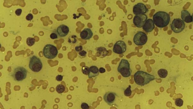 Egy mielma multiplexben szenved beteg plazmasejtjei (Forrs: Wikimedia Commons/Dr Erhabor Osaro - CC-BY-SA)
