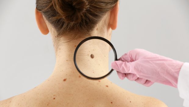 Bőrrákok (nem melanoma) tünetei és kezelése - HáziPatika