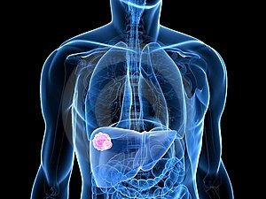 A rák lymphoma Hodgkin tünetei. A rák jelei és tünetei Rák