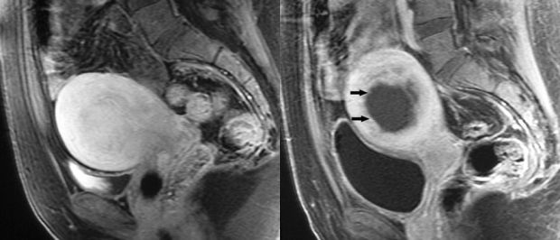 Mióma embolizáció előtt és után. Forrás: Radiology