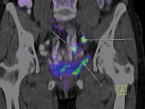 Endo-Kapszula Magánorvosi Centrum - Cikkek - Hasnyálmirigy daganat