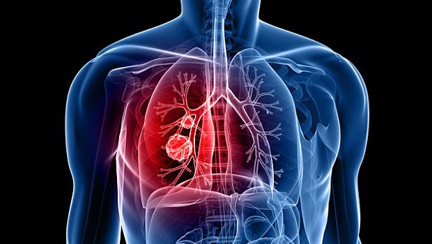 tüdőrák kezelési lehetőségek, kutatási eredmények
